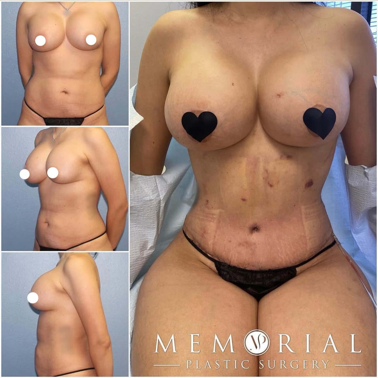 2 weeks post-op 🫶🏼
She is still in the healing stage and bruising but you can already appreciate her new shape 💖
Procedure: Tummy Tuck, Lipo360 + Implant Exchange using 700cc High Profile silicone implants
(Pre Sx: Ht: 5’6 Wt: 154 lbs BMI: 24.9)
#beforeandafter #roehldoll #newbody #breastimplants #breastaugmentation #siliconeimplants #houstonplasticsurgery #houstonplasticsurgeon @memorialplasticsurgery