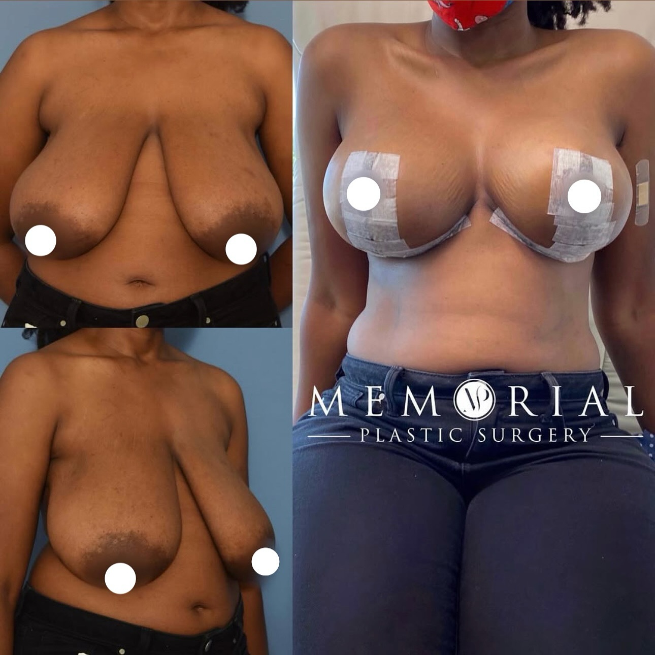 9 day post-op #breastreduction results 🤩👏🏼. New size, new shape, NO implants! 🙌🏼👍🏼 (Pre-Sx Wt: 160 lbs Ht: 5’6 BMI: 25.8 Bra Size: 34H)
#beforeandafter #breastsbyhsu #breastreduction #transformation #houstonplasticsurgeon #houstonplasticsurgery @memorialplasticsurgery