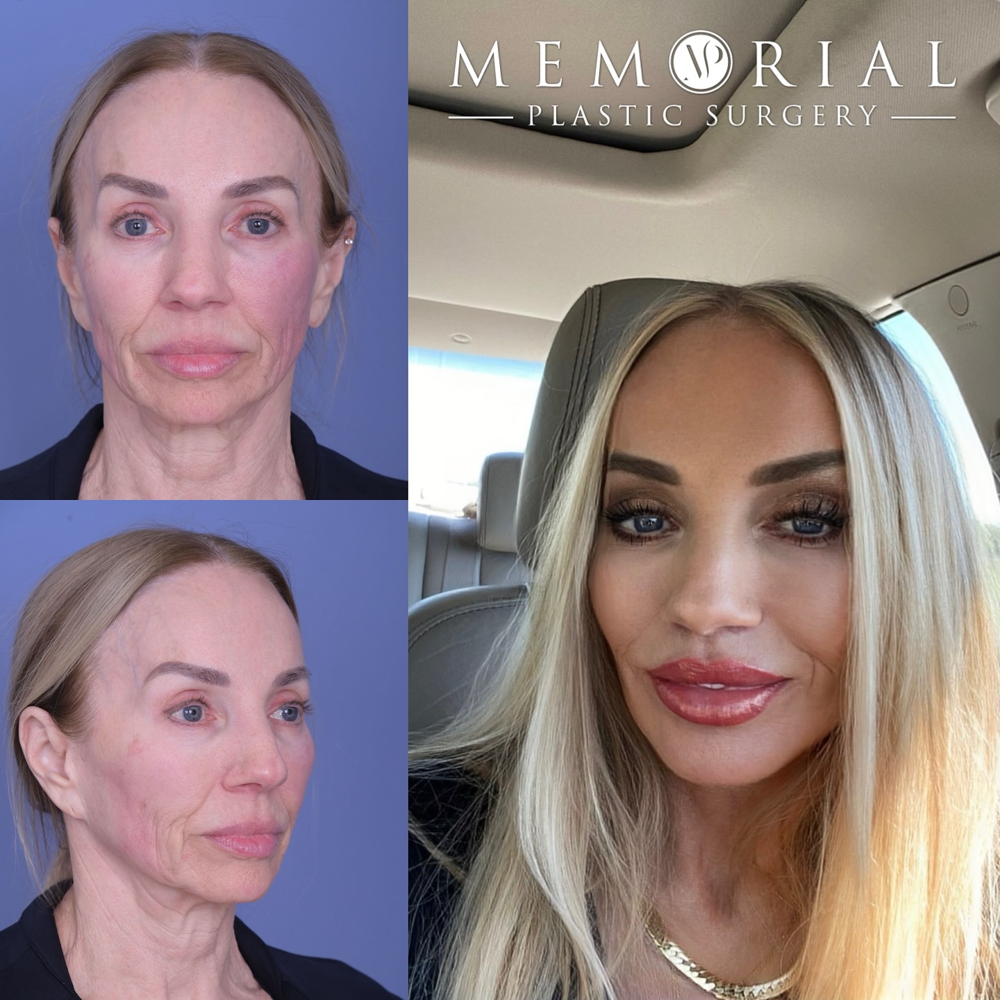 Gorgeous result at 3 months post-op with a Deep Plane Facelift, Deel Neck Lift, Lip Lift + Full Face CO2 laser 🔥🔥
Looking refreshed and confident! We love it when patients send us selfies of their great results! 🤩
#CO2laser #3monthspostop #facelift #MPSface #necklift #upperliplift #facialtransformation @memorialplasticsurgery