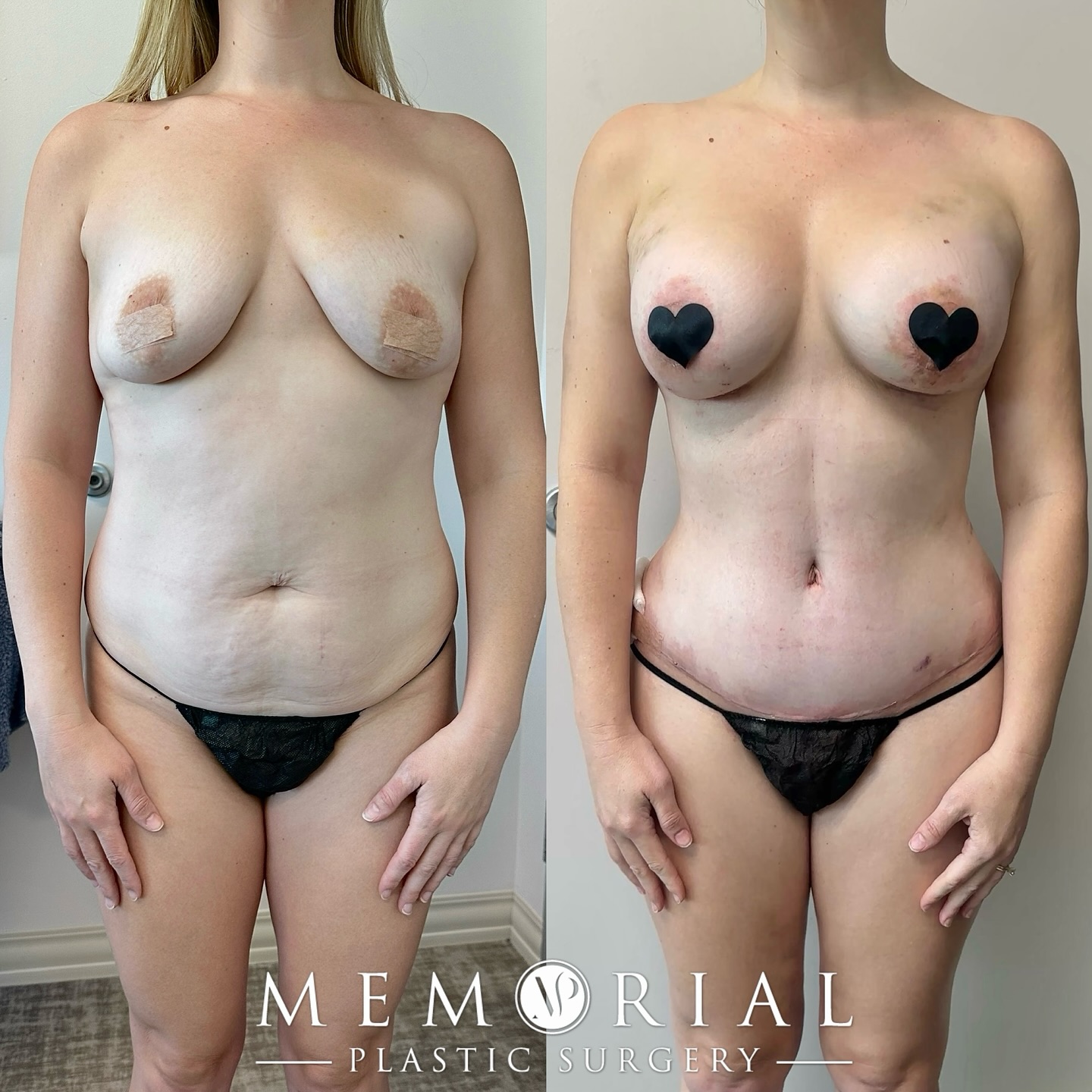 10 days post-op looking amazing 🤩😮💨🔥
Procedure: Tummy Tuck, Breast Lift w/ implants, Lipo360, BBL, Lipo to arms, thighs + submental
(Pre-Sx Wt: 148 lbs Ht: 5’4 BMI: 25.4)
#beforeandafter #mommymakeover #plasticsurgery #houstonsurgeon #houstontx @memorialplasticsurgery