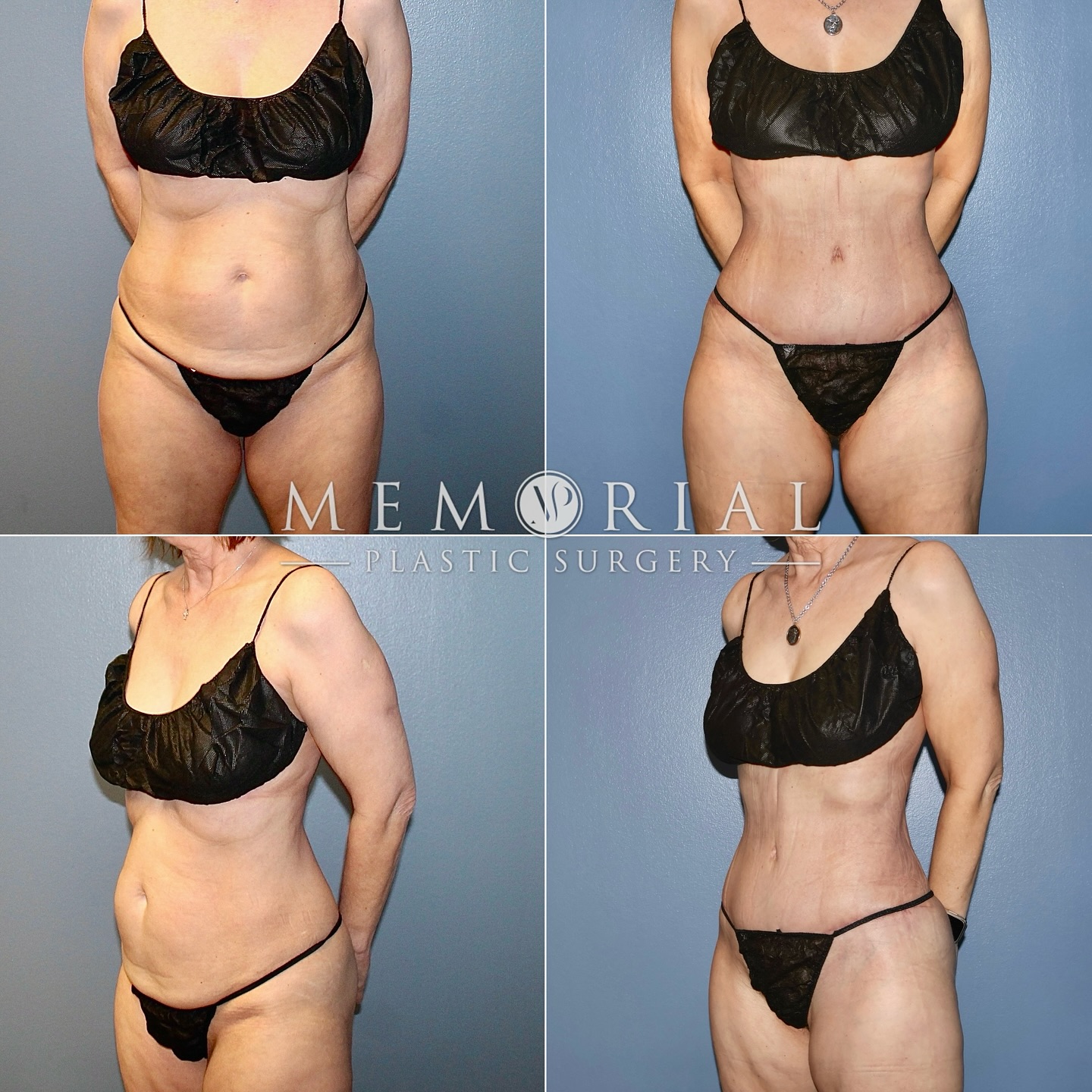 8 weeks post-op 😍😍 in her 60s and looking amazing!! ✨
Procedure: Tummy Tuck + Lipo to flanks 🙌🏼
(Pre-Sx Wt: 128.6 lbs Ht: 5’3 BMI: 23.7 Bra Size: 32F)
#beforeandafter #bodytransformation #newbody #femaleplasticsurgeon #plasticsurgery @memorialplasticsurgery