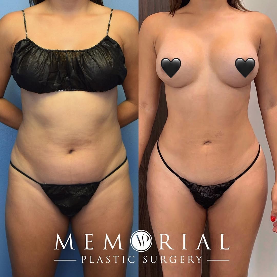 Looking amazing after the perfect amount of 4D hi-def lipo to highlight her abdomen for an athletic contour, while still keeping it natural and feminine 👌🏼🤩
Procedure: BBL, Lipo360, Lipo to arms + inner thighs 🔥
(Pre-Sx Wt: 130 lbs. Ht: 5’3. BMI: 23)
#beforeandafter #BBL #liposuction #houstonplasticsurgeon @memorialplasticsurgery