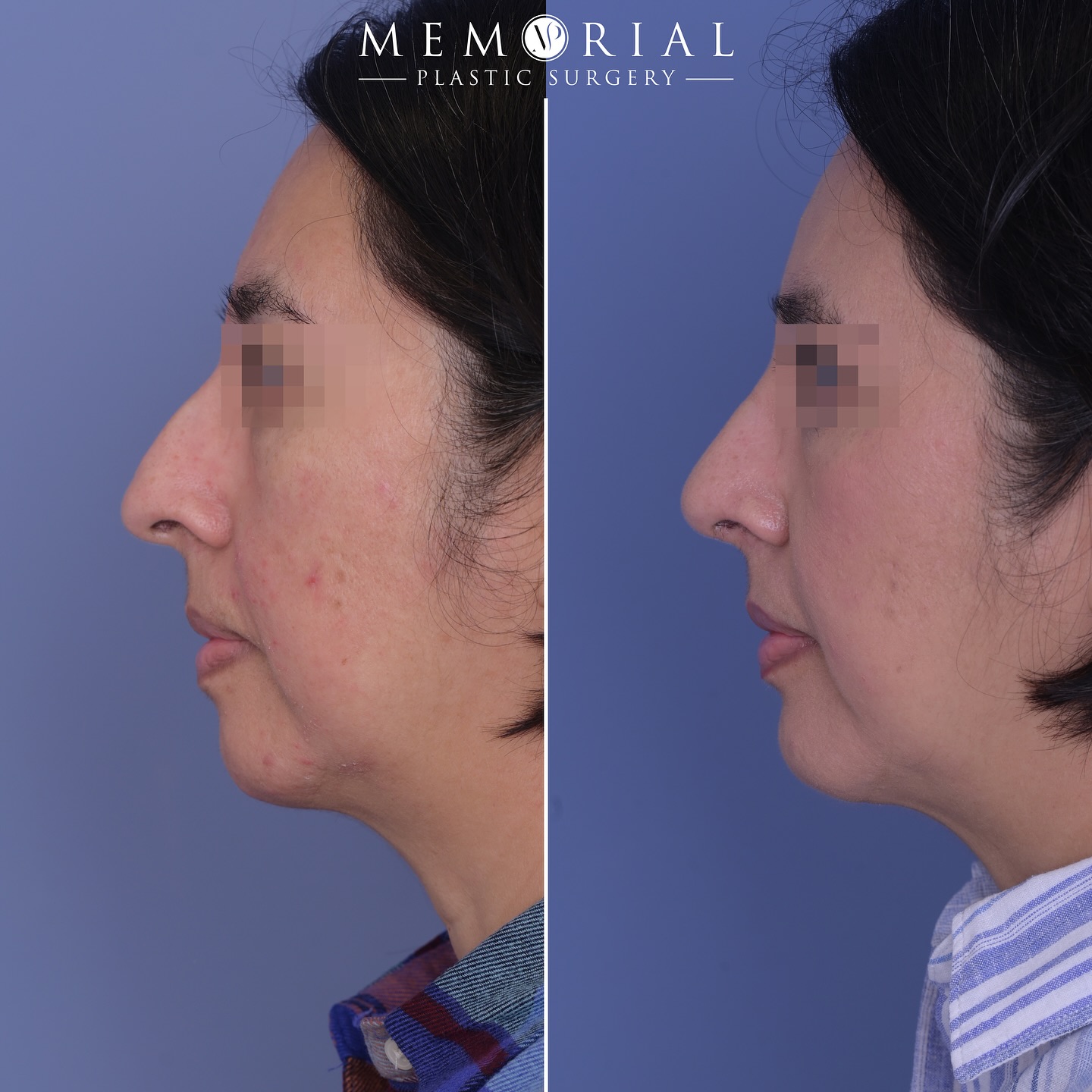 Beautiful 3 month post-op result of a #Rhinoplasty + #ChinAugmentation 🔥🔥
#beforeandafter #nosejob #newnose #facialplasticsurgery #MPSFace @memorialplasticsurgery