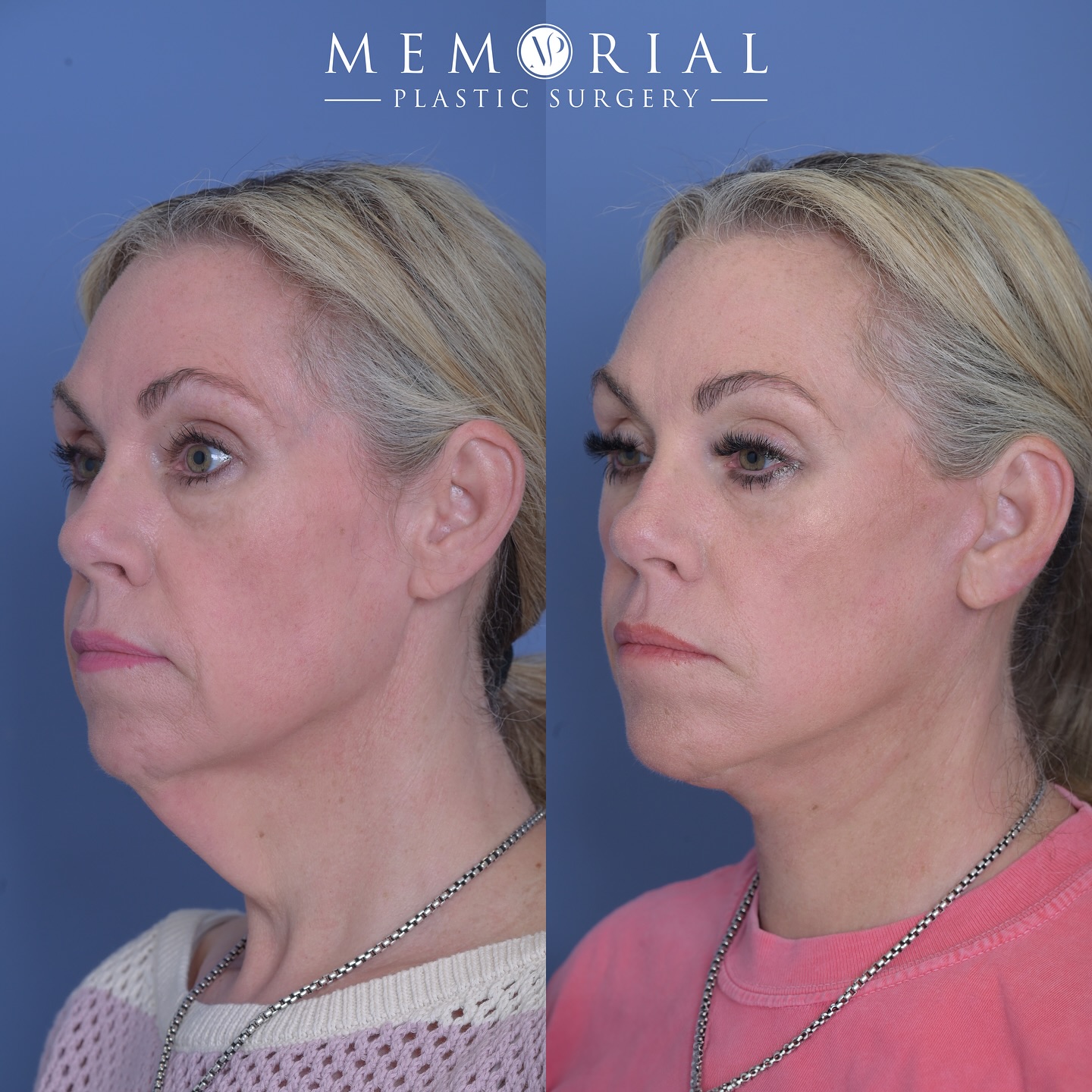 This absolutely wonderful patient came to me because she’s always had excess skin in her neck — even when she was much younger. It’s always bothered her, and she felt everyone recognized it. We’re early in her recovery from a facelift and necklift, but we’re both so happy for such a massive but natural-looking difference already!
#naturalresults #facelift #necklift #plasticsurgeon #facialplasticsurgery #MPSFace #drmcelwee @memorialplasticsurgery