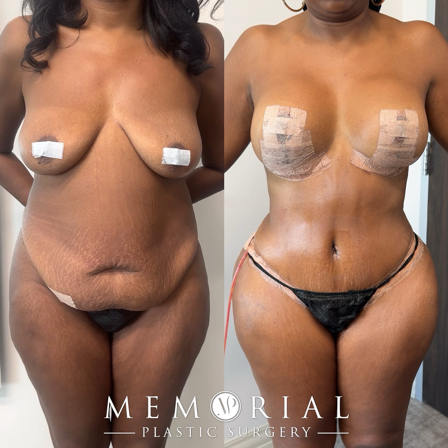 3 days post-op Mommy Makeover looking amazing!! 🤩🙌🏼
Procedure: Ext. Tummy Tuck, Breast Lift w/ implants, Lipo360, BBL + J-Plasma to back 🔥
(Pre-Sx Wt: 154 Ht: 5’4 BMI: 26.4)
#mommymakeover #beforeandafter #plasticsurgery #tummytuck #breastsurgery #drhsu @memorialplasticsurgery