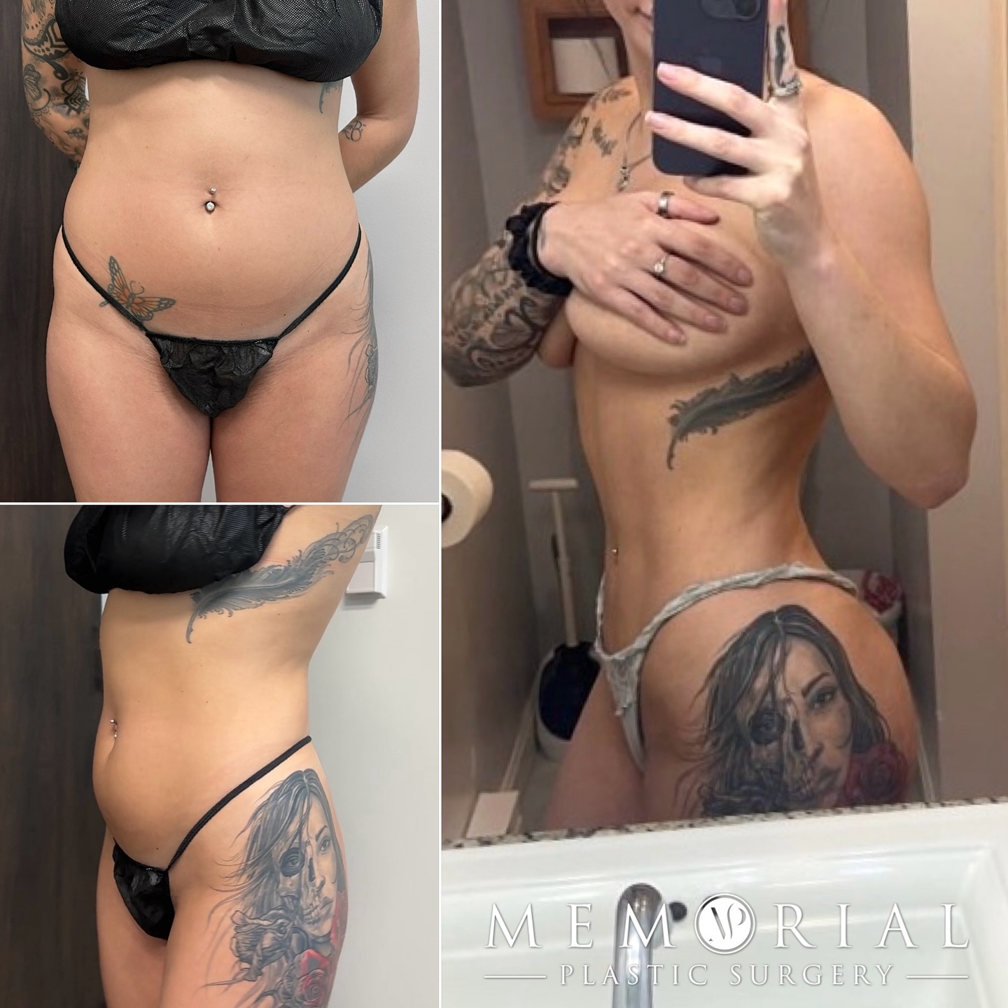 HSU BODY at 6 weeks post-op 🔥🔥
Procedure: Skinny BBL, Lipo360 w/hi-def ab etching 😍 (Pre-Sx Wt: 130 lbs Ht: 5’5 BMI: 21.6)
#beforeandafter #abetching #bbl #brazilianbuttlift #newbody #skinnybbl #plasticsurgery #houstonplasticsurgeon @memorialplasticsurgery