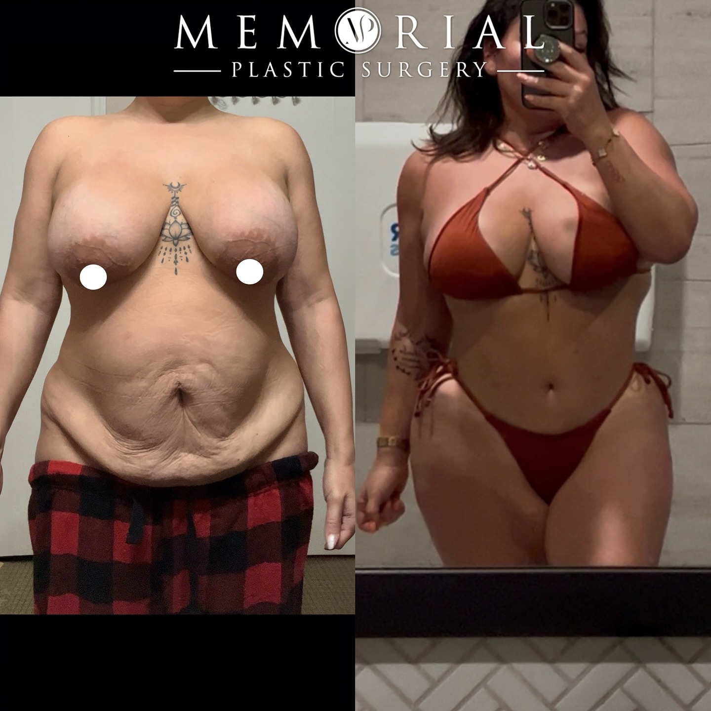 Summer body at 9 months post-op 🔥🔥😍
Procedure: Tummy Tuck, Lipo360, Breast Lift w/ Implant Exchange
(Pre-Sx Wt: 162 lbs Ht: 5’1 BMI: 30.6)
#mommymakeover #bodytransformation #newbody #plasticsurgery #drvasilakis @memorialplasticsurgery