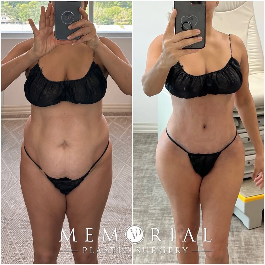 2 week post-op mommy makeover result! 🔥🙌🏼 This beautiful patient has a brand new body after 4 children and she’s looking amazing 😍
Procedure: Tummy Tuck, BBL, Lipo360 + J Plasma to back (Pre-Sx: Wt: 125 lbs Ht: 5’0 BMI: 23)
#mommymakeoversurgery #plasticsurgery #drhsu #houstonplasticsurgeon @memorialplasticsurgery