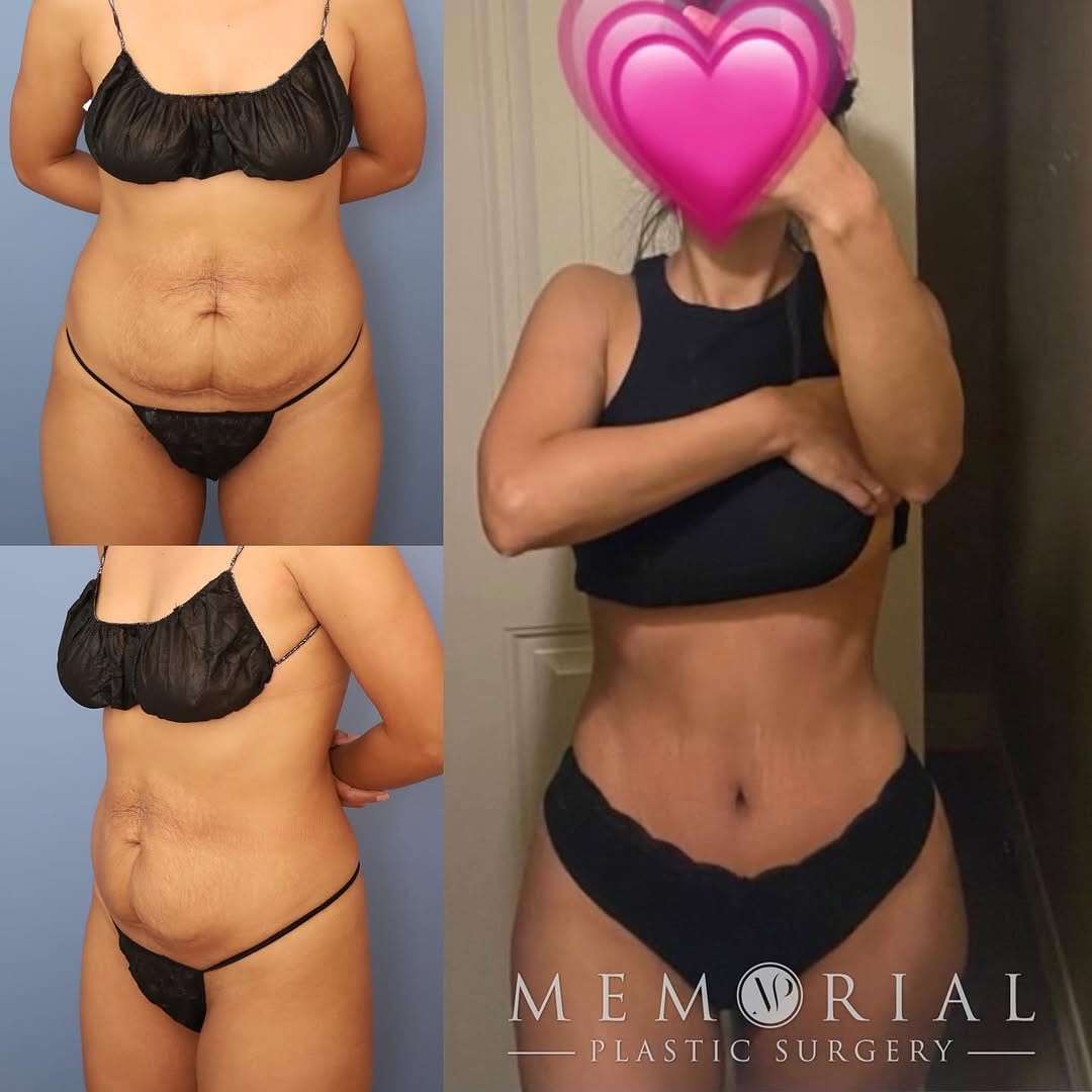Beautiful result 2 months following: Tummy Tuck, BBL, Lipo360 + Lipo to the thighs 🔥
(Pre-Sx: Wt: 130 lbs Ht: 5’3 BMI: 23)
#mommymakeover #tummytuck #bbl #lipo360 #transformation #drvasilakis #houstonplasticsurgery @memorialplasticsurgery