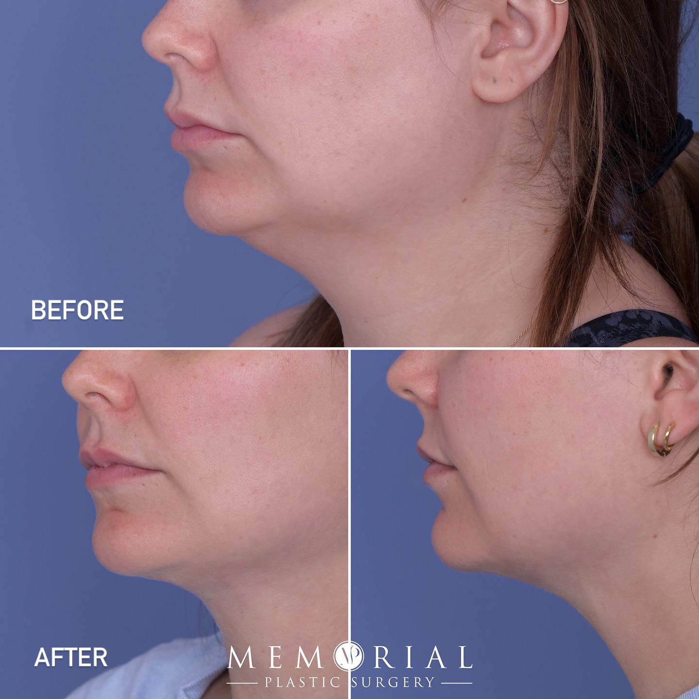 Chin liposuction result at just 2.5 months post-op 👌🏼🙌🏼
#submentallipo #beforeandafter #facialplasticsurgery #drmcelwee @memorialplasticsurgery