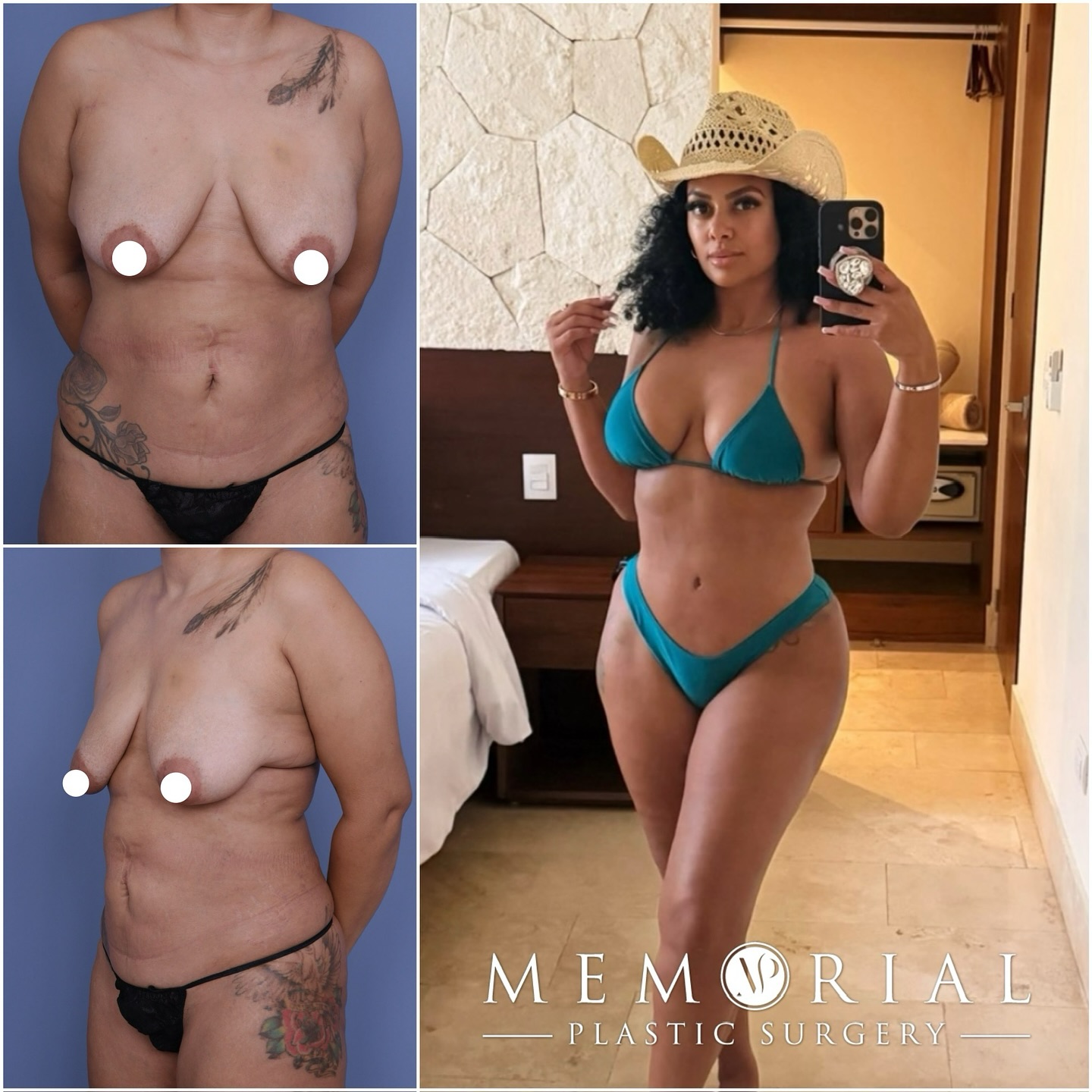 Vacation body looking right! 🔥🔥😎 living her best life 👏🏼
Procedure: Tummy Tuck, Breast Lift w/ implants, BBL, Lipo360 + Lipo to arms
(Pre-Sx Wt: 155.8 lbs Ht: 5’4 BMI: 26.7)
#beforeandafter #mommymakeover #bikinibody #hsubody #snatched #plasticsurgery #houstonplasticsurgeon @memorialplasticsurgery