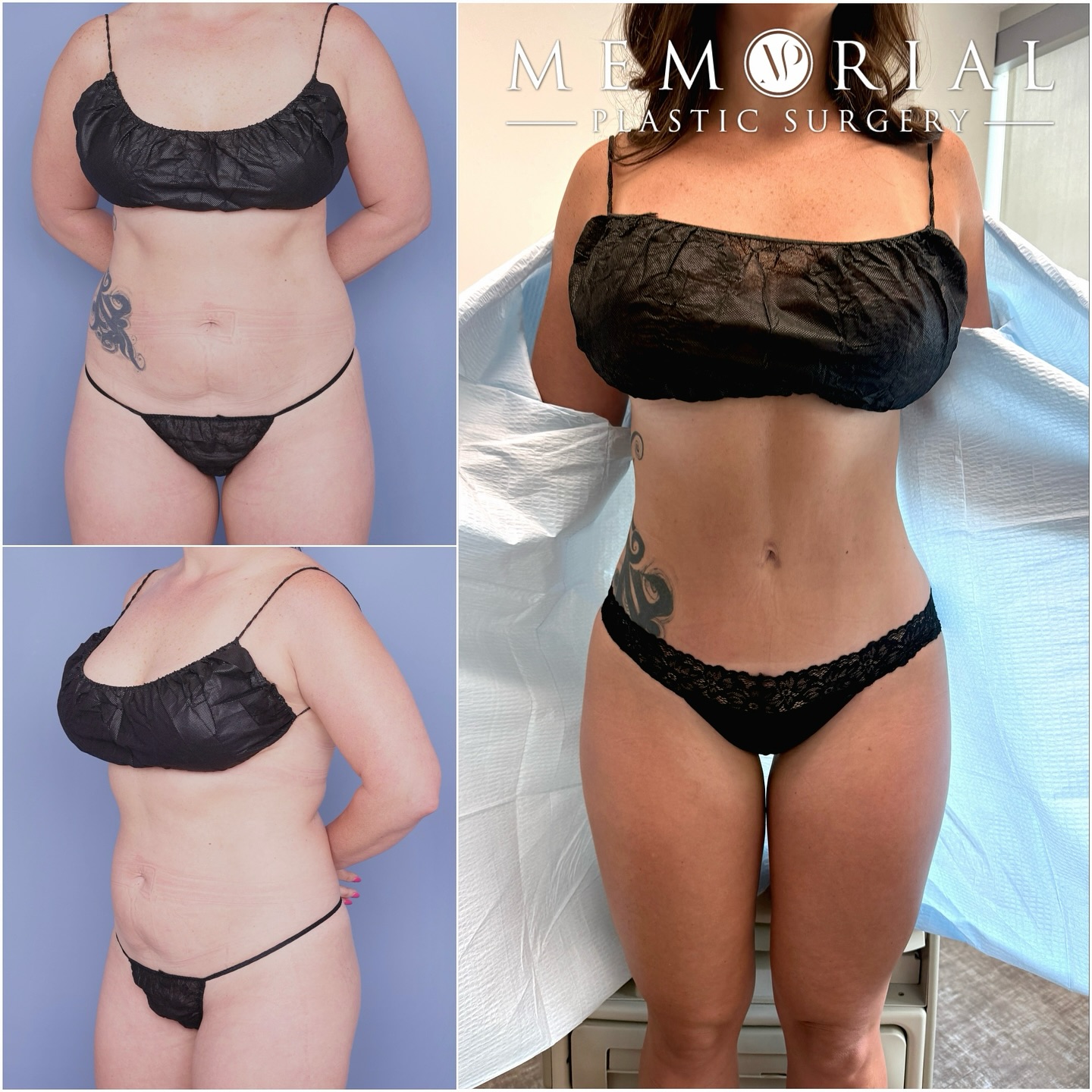 3 months post-op #bodybyhsu 🔥🤩👌🏼
Procedure: Tummy Tuck, BBL + Lipo360
(Pre-Sx Wt: 168 lbs Ht: 5’7 BMI: 27.4)
#beforeandafter #mommymakeover #hsubody #bodybyhsu #plasticsurgeon #houstonplasticsurgeon @memorialplasticsurgery