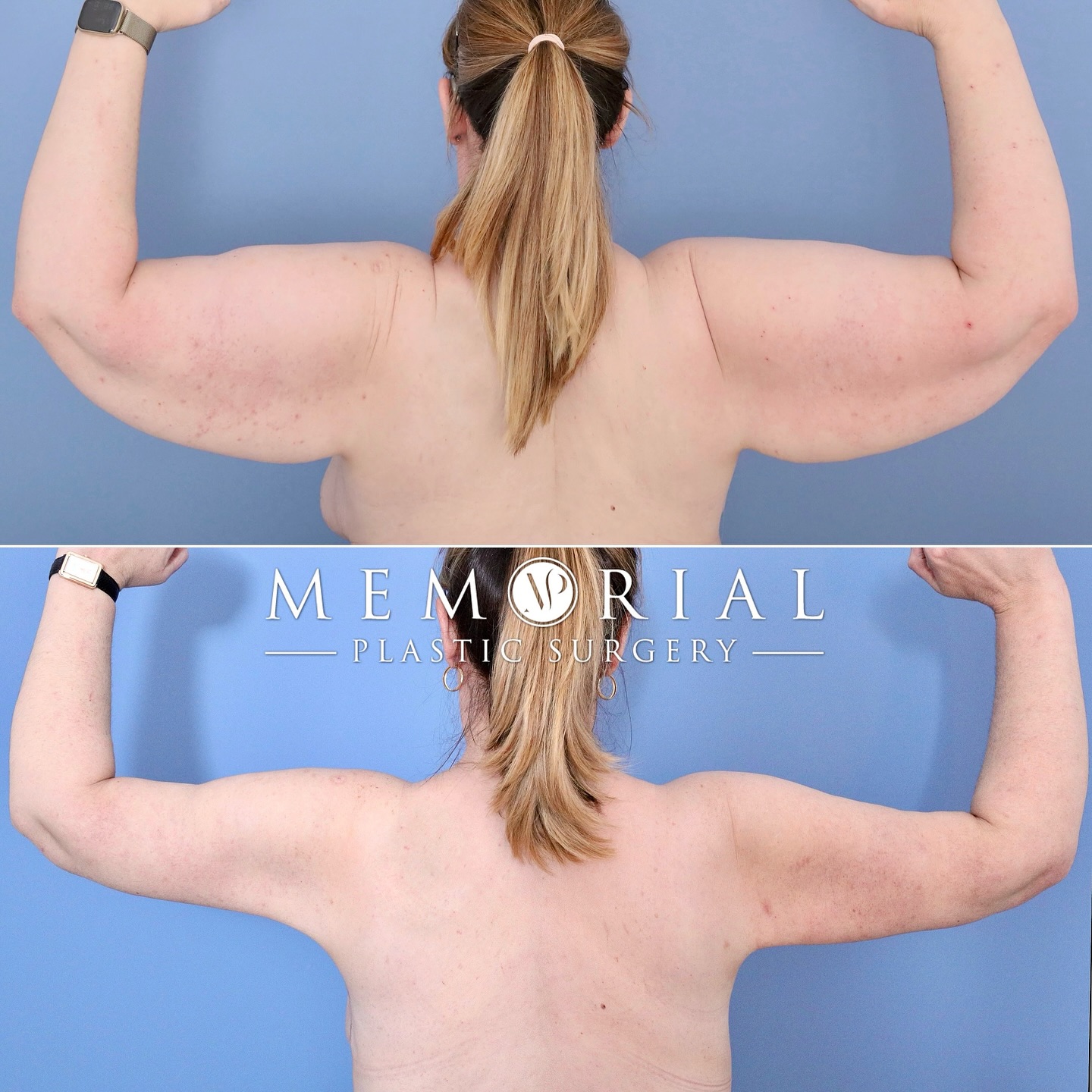 Dramatic result at 1 year following Arm Lift! 💪🏼🔥🔥
#100lbweightloss #armlift #brachioplasty #majorweightloss #transformation #skinremovalsurgery @memorialplasticsurgery