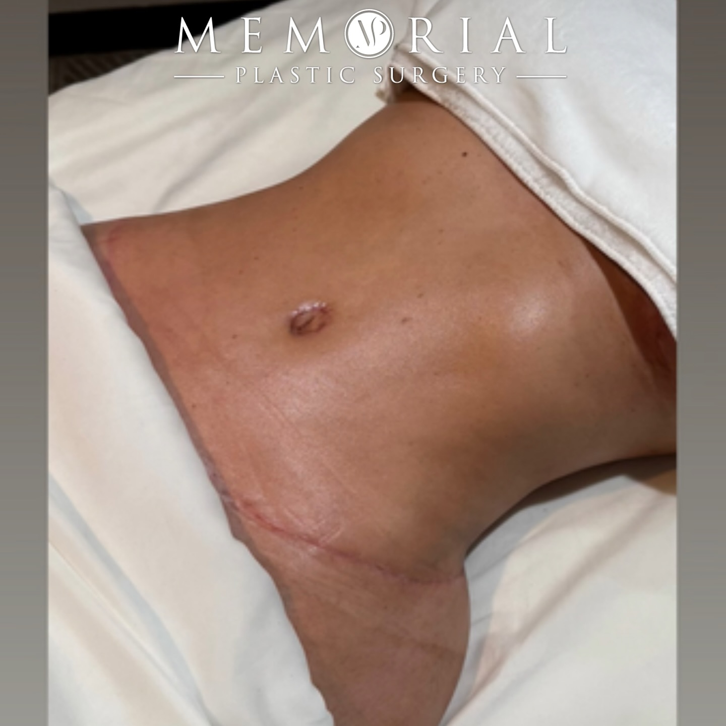 Tummy Tuck + Lipo360 result for my patient👌🏼 8 months post-op and looking beautiful 🤩
(Pre-Sx Wt: 146 lbs Ht: 5’3 BMI: 25.9)
Thank you @premiertherapeuticmassage for taking great care of my patient 🙏🏼
#beforeandafter #bodylift #snatchedwaist #mommymakeover #plasticsurgery #houstontx @memorialplasticsurgery