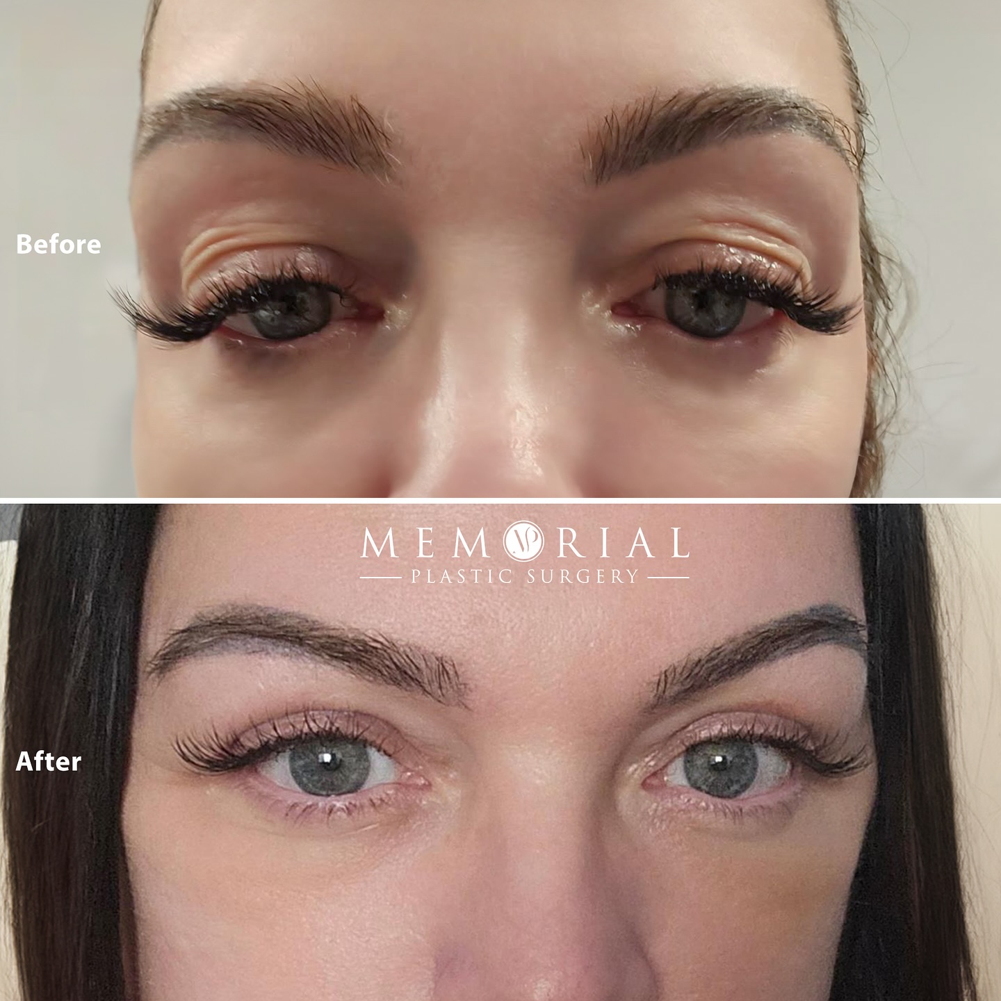 Feeling fresh but looking tired? Hooded lids making your morning routine tougher than it needs to be? I’ve got you covered.
Procedure:
🔹 Upper blepharoplasty
As always, questions & comments below ⬇️
#eyelidsurgery #uppereyelids #facialplasticsurgery #MPSFace @memorialplasticsurgery
