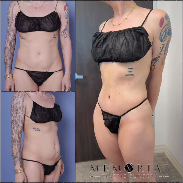 Gorgeous natural result at 3 months post-op 🤩🙏🏼

Procedure: Ext. Tummy Tuck + Lipo to flanks 
(Pre-Sx Wt: 132.2 lbs Ht:5’2 BMI: 24.2)

#beforeandafter #mommymakeover #tummytuck #liposuction #plasticsurgeon @memorialplasticsurgery