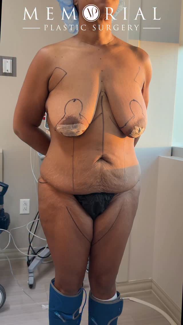 Gorgeous on-table result for my lovely patient 😍😍💖
Procedure: Circumferential Body Lift, Breast Lift w/ implants, BBL, Lipo360 + Lipo to inner thighs 🔥
(Pre-Sx Wt: 167.8 lbs Ht: 5’6 BMI: 27.1)
#mommymakeover #bodytransformation #bodylift #excessskinremoval #femaleplasticsurgeon @memorialplasticsurgery