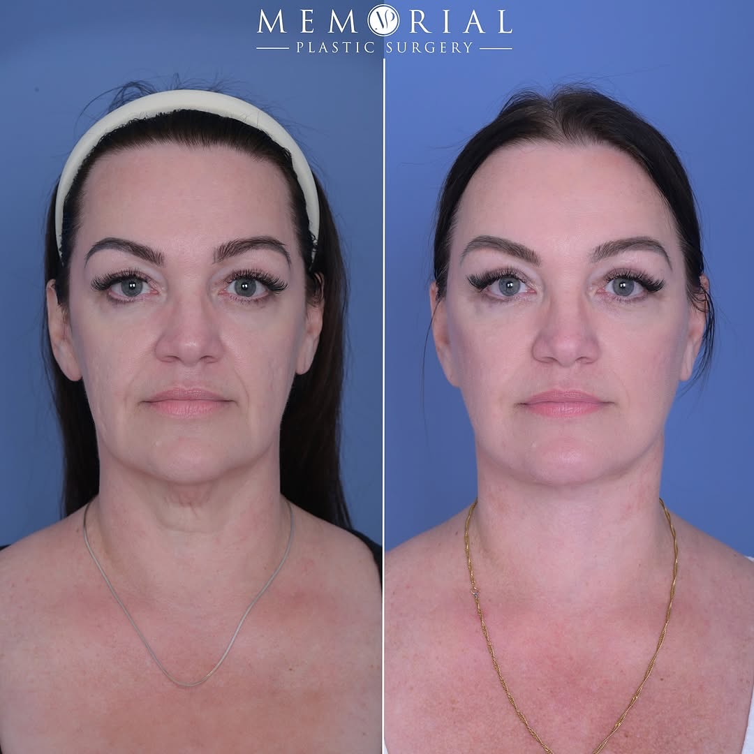 REPOST of this amazing transformation by @dr.tylermcelwee 🤩👏🏼 She’s only 1 month post-op 🔥
Procedures: Facelift, Neck Lift, Brow Lift + Upper Blepharoplasty
#MPSFace #facialplasticsurgery #facialcosmetics #houstonplasticsurgeon @memorialplasticsurgery