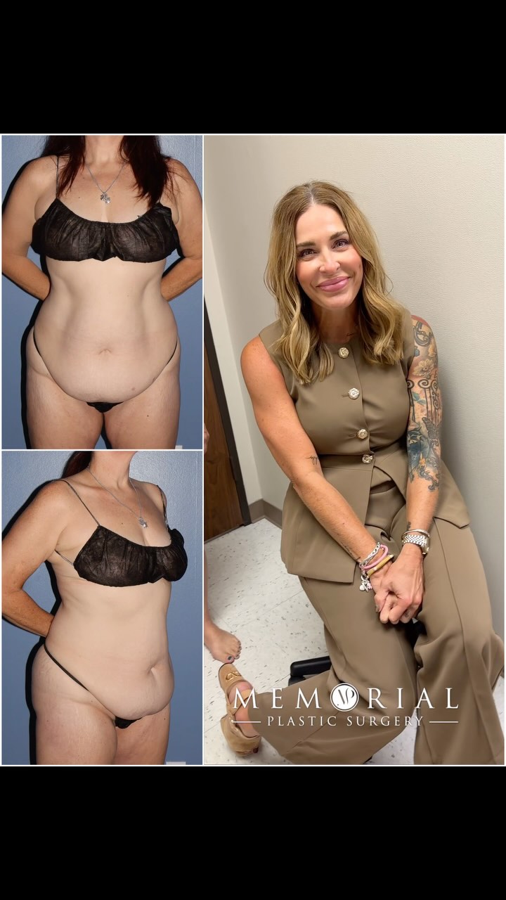 Another Tuesday, another clinic win! 🤩 
My lovely patient is 2.5 months post-op and feeling great with her new & improved waistline☺️ — we’re both loving the way her results are coming together✨
Procedure: Lipo to Flanks + Tummy Tuck👏🏻
(Pre-Sx Wt: 162 Ht: 5’4 BMI: 27.8)
#beforeandafter #newbody #bodytransformation #tummytuck #liposuction #femaleplasticsurgeon #memorialplasticsurgery @memorialplasticsurgery