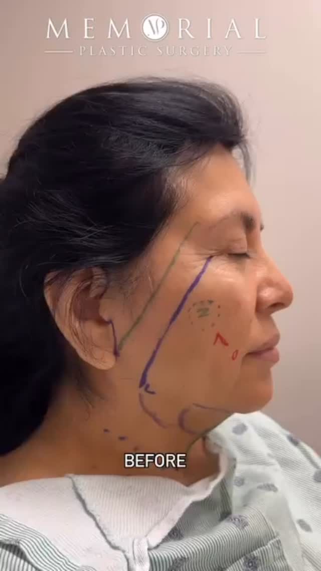 Almost 2 months post-op looking refreshed after getting a #Facelift, #NeckLift + #SubmentalLiposuction 😍🤩
#facialplasticsurgery #facialrejuvenation #faceliftrecovery #facialplasticsurgeon #MPSFace @memorialplasticsurgery