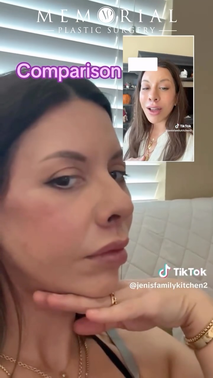 One of my favorite parts of facial rejuvenation is guiding patients through the process—not just the before/after. This patient has been sharing her whole journey, and the transformation is already incredible even while swelling continues to settle. 
Our goals: lift, refine, and restore harmony while preserving her natural character. Notice how she still looks like herself, but so refreshed and rejuvenated. I am so grateful for her trust!! Everyone follow along from her TikTok @jenisfamilykitchen2 
Procedures:
🔹Deep plane facelift
🔹Deep structural neck lift
🔹Endoscopic brow lift
🔹Lower lid blepharoplasty
🔹Fat grafting / transfer
🔹Deep plane lip lift Neck Lift, 🔹CO2 laser to under eyes
As always, questions & comments below 💬
#Facelift #Necklift #EndoscopicBrowLift #LowerBlepharoplasty #FatGrafting #CO2Laser #UpperLipLift #FacialRejuvenation #PlasticSurgery #NaturalResults #PatientJourney