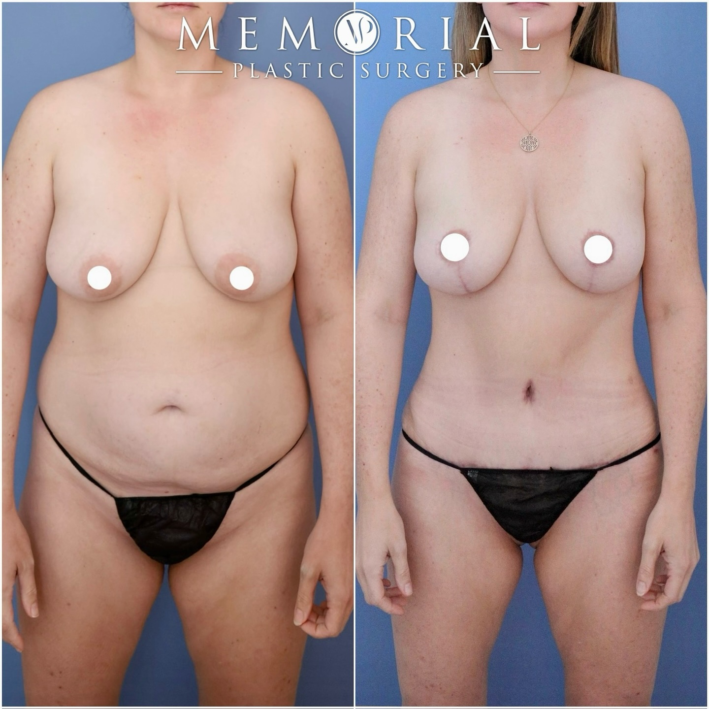 Love this before & after result of my amazing patient, at 4 months post MommyMakeover surgery! 🔝👌

Procedure: Tummy Tuck, Lipo360, Lipo to Arms, Breast Lift & Fat Grafting to Breasts. 
(Pre-Sx Wt: 171 lbs Ht: 5’7 BMI: 26.8 Bra Size: 38D)

#mommymakeover #transformation #tummytuck #bodytransformation #breastlift #plasticsurgery #houstonplasticsurgeon @memorialplasticsurgery