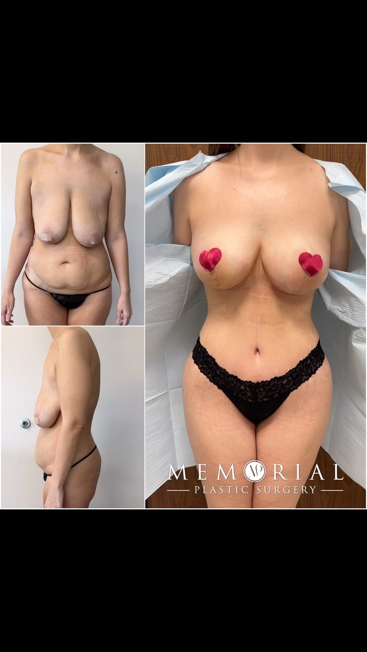 Gorgeous before and after at just under 4 weeks post-op!😍 
Lifted, snatched, and absolutely loving the transformation! Breast lift doing its thing and waist line coming through beautifully☺️🫶🏻
Procedure: Lipo360, Tummy Tuck, BBL, Brachioplasty + Breast Lift👏🏻
(Pre-Sx Wt: 165 lbs Ht: 5’4 BMI: 28.3)
#beforeandafter #transformation #breastlift #femaleplasticsurgeon #houstonplasticsurgeon #memorialplasticsurgery @memorialplasticsurgery