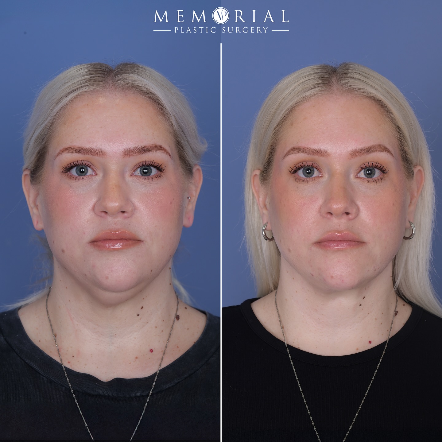 Love how we’re shaping up at 3 months here. This wonderful patient didn’t love the little fullness she has in her submentum, and it’s something that just liposuction couldn’t properly address. It’s only going to refine more as the last bit of swelling continues to go down!
Procedure: 
🔹Deep Structural Neck Lift 
#necklift #facialplasticsurgery #facialcosmetics #houstontx #MPSFace @memorialplasticsurgery