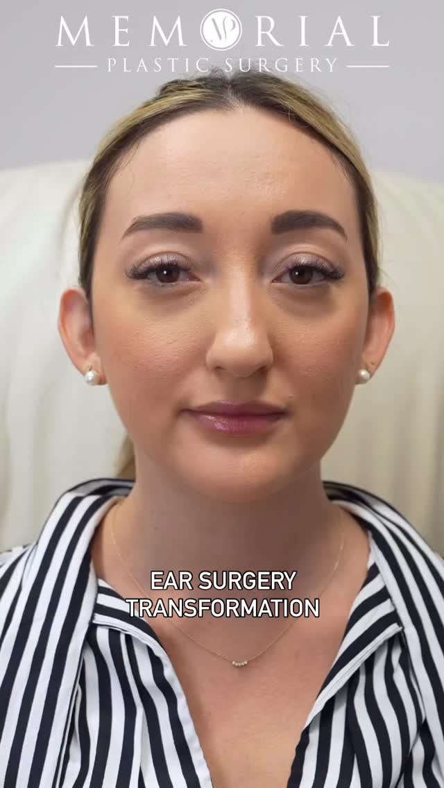 Great #Otoplasty result for one of my lovely patients! 👍🏼
#beforeandafter #facialplasticsurgery #houstonplasticsurgeon #facialcosmetics #MPSFace @memorialplasticsurgery