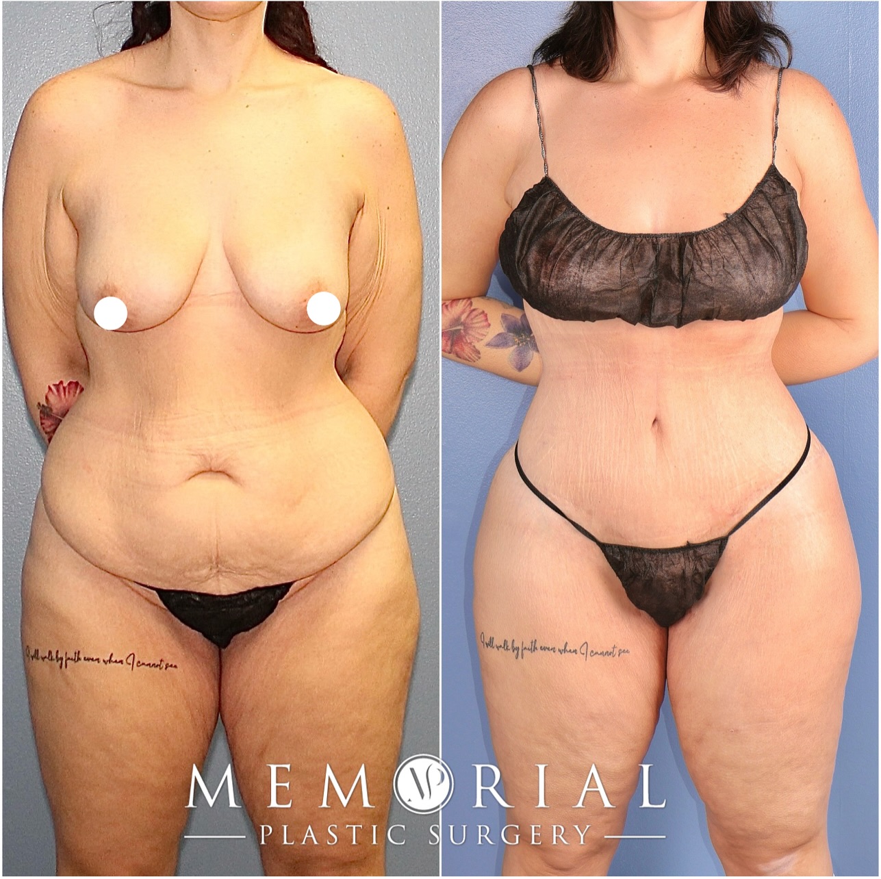 Swipe to see a transformation that speaks for itself🤩
This patient’s beautiful results enhances her natural features and highlights her new shape in the best way!🤭😍
Procedure: BBL, Lipo360 + Lipo to Arms, Circumferential Body Lift + Ext. Brachioplasty✨
(Pre-Sx Wt: 176.6 Ht: 5’5 BMI: 29.4)
#beforeandafter #transformation #bbl #newbody #femaleplasticsurgeon #memorialplasticsurgery @memorialplasticsurgery