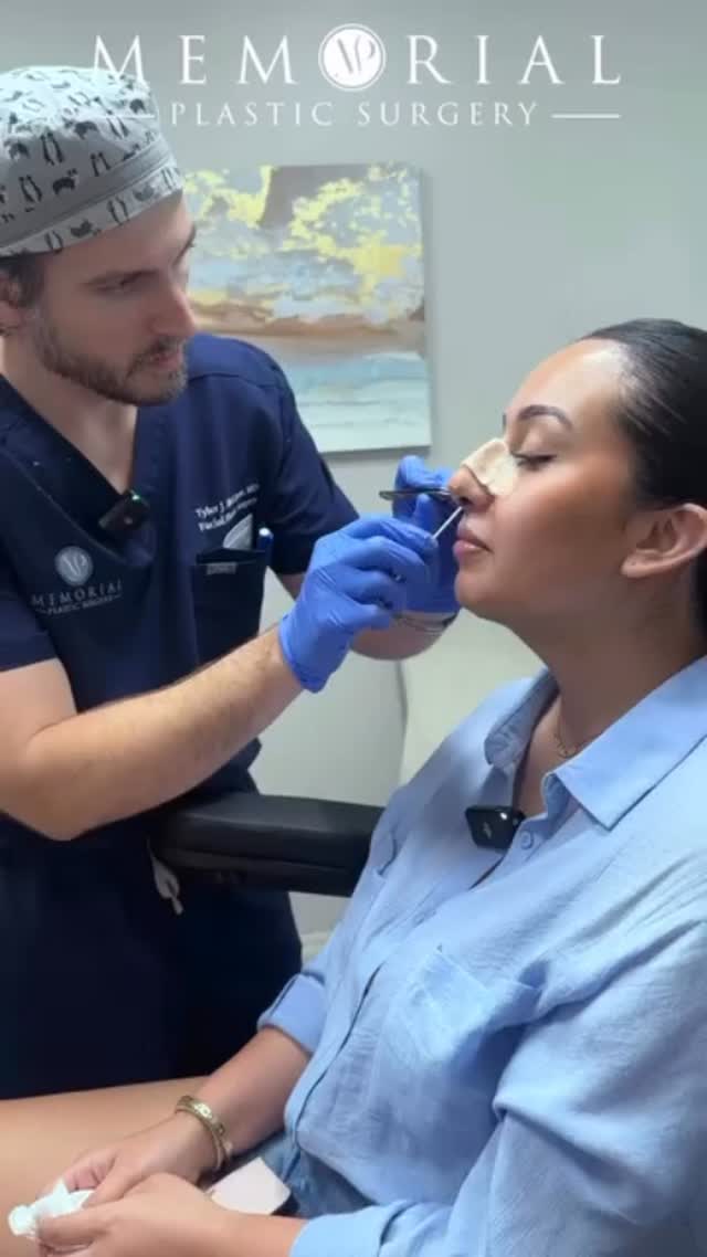 The big reveal is such a monumental moment in my patients journey so it’s always exciting to be apart of it! Here’s a little behind the scenes of a follow up appt with one of my amazing patients getting the cast off her new nose for the first time👃🏼 
There’s definitely still a good amount of swelling but she’s already loving her result. Like all fine things, it will only get better with time!
Procedure: Rhinoplasty, Septoplasty + Chin Liposuction
#beforeandafter #reveal #nosejob #rhinoplasty #chinlipo #drmcelwee #MPSFace #houstonplasticsurgeon @memorialplasticsurgery