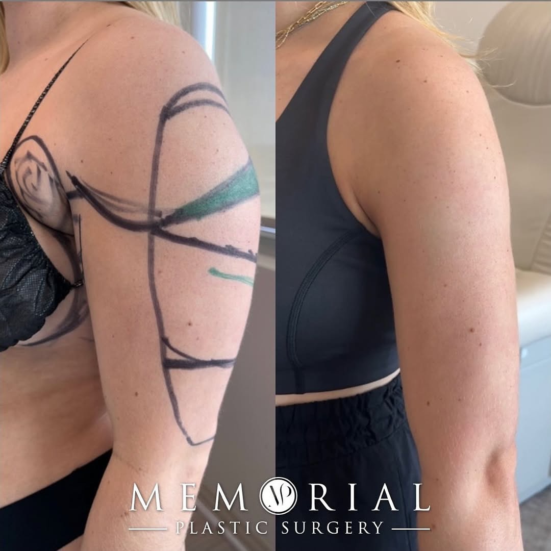 Arms looking slim and toned at 6 months post-op 💪🏼🤩🔥🔥
Procedure: Liposuction to arms
(Pre-Sx: Wt: 150 Ht: 5’3 BMI: 26.6)
#liposuction #transformationTuesday #armtransformation #slimarms