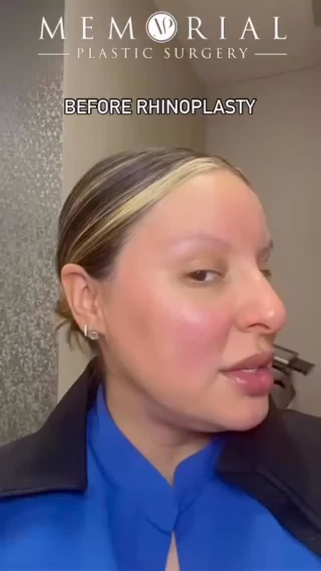 6.5 months post-op & looking great!! This #Rhinoplasty result highlights how subtle refinements can create a beautifully balanced and natural look👌🏼 
#nosejob #septoplasty #facialplasticsurgery #facialrejuvenation #naturalresults #houstonplasticsurgery #MPSFace @memorialplasticsurgery