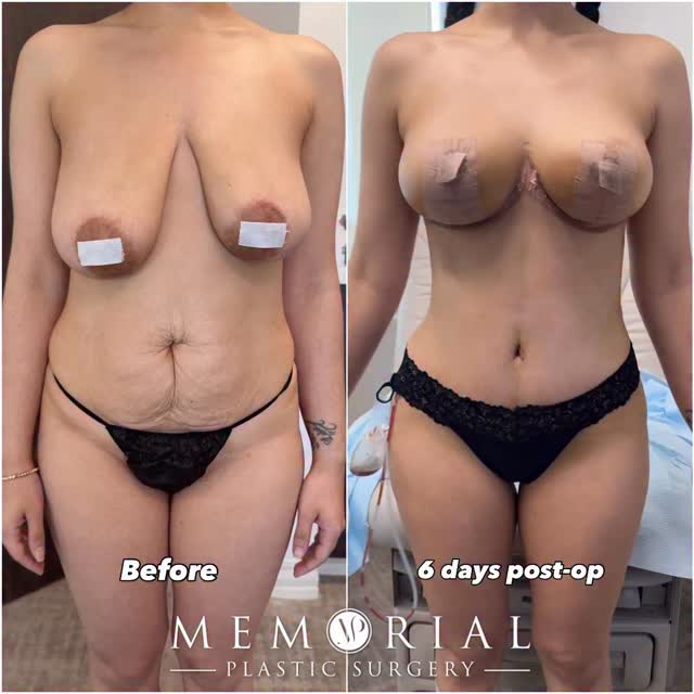 🔥🔥🔥 #BODYBYHSU
Procedure: Tummy Tuck, Breast Reduction, Lipo360
(Pre-Sx Wt: 122.6 lbs Ht: 5’2 BMI: 22.42)
#drhsu #texassurgeons #plasticsurgery #houstonplasticsurgeon #mommymakeover @memorialplasticsurgery