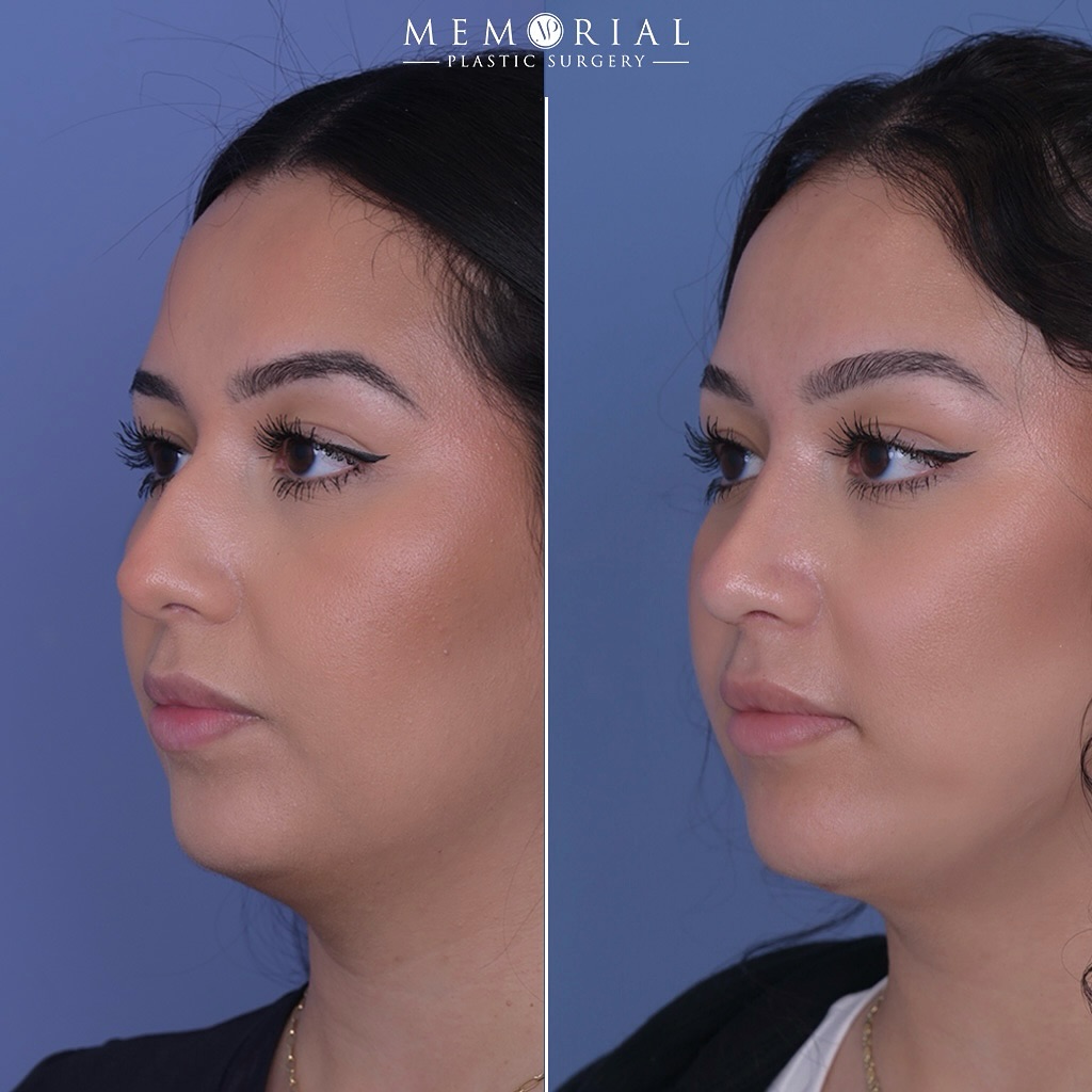 ✌🏻months postop. What I love most is how well it suits her face and blends right in, giving a sense of harmony. What I love second most is that you can’t tell she’s had a rhinoplasty — it looks like the nose that’s always fit her face.
Procedures:
🔹Rhinoplasty
🔹Septoplasty
#nosejob #facialplasticsurgery #facialrejuvenation #MPSFace @memorialplasticsurgery