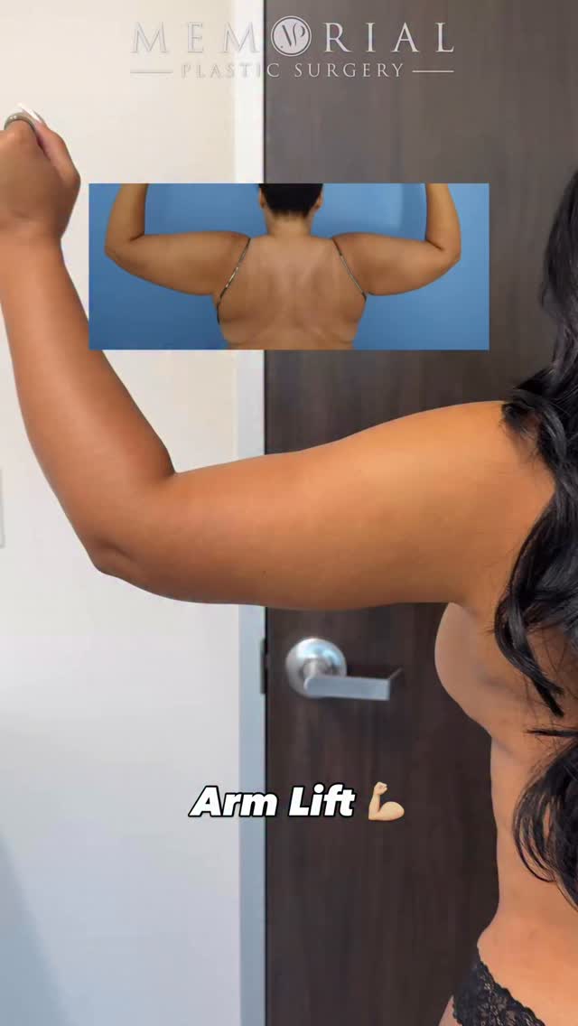 Arm Lift result looking 🔥🔥😎
(Pre-Sx Wt: 155.8 lbs Ht: 5’4 BMI: 26.7)
#armsurgery #armlift #brachioplasty #drhsu #houstonplasticsurgeons @memorialplasticsurgery