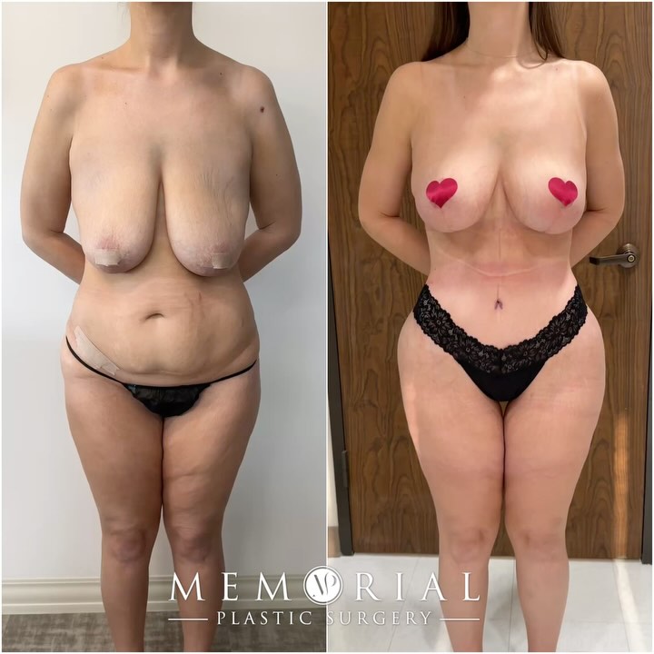 Who is she?!😍 Her waist is trimmed and she’s looking absolutely phenomenal at 2 months post-op!🥰🤩 + swipe to the right, you don’t want to miss the back🤭🍑

Procedure: Lipo360, Tummy Tuck, BBL, Brachioplasty + Breast Lift👏🏻
(Pre-Sx Wt: 136lbs Ht: 5’4 BMI: 23.3)

#beforeandafter #transformation #bodytransformation #bbl #lipo360 #memorialplasticsurgery #femaleplasticsurgeon @memorialplasticsurgery