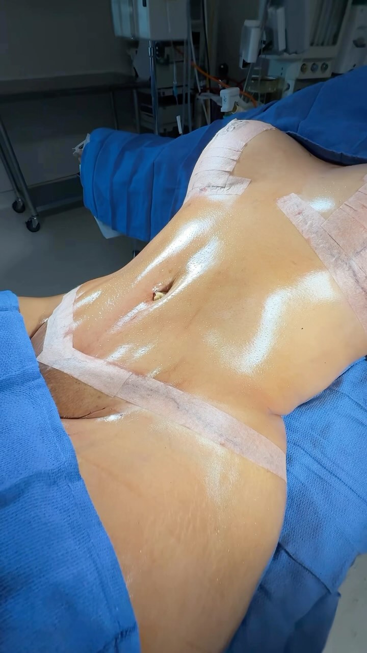 On-table transformation going hard💪🏼🔥

Procedure: BBL, Lipo360 + Lipo to Inner Thighs, J-Plasma to Back & Arms + Breast Lift w/ Augmentation👌🏼

#beforeandafter #newbody #breastaugmentation #houstonplasticsurgery #memorialplasticsurgery @memorialplasticsurgery