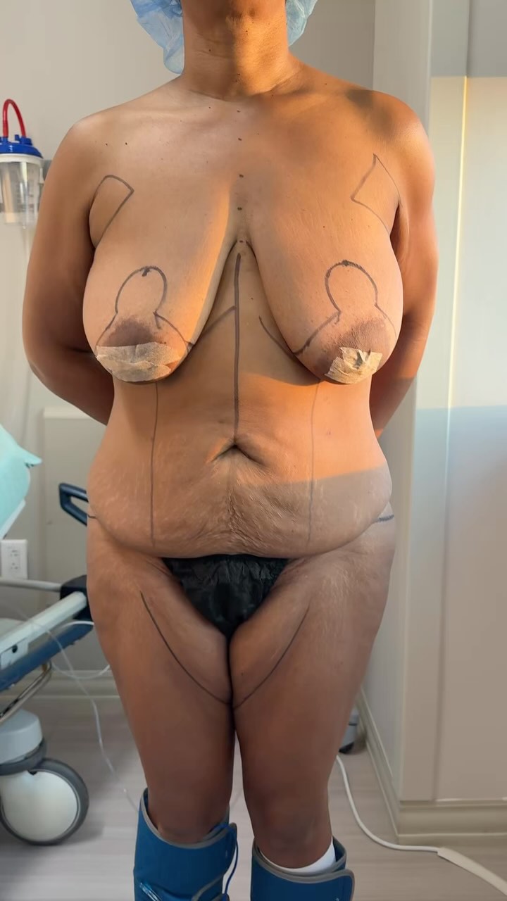 Beautiful before and after transformation at just 4 weeks post-op!🤩☺️👏🏻
Procedure: BBL, Lipo360 + Lipo to Inner Thighs, Circumferential Body Lift + Breast Lift w/ Implants🫶🏻
(Pre-Sx Wt: 167.8lbs Ht: 5’6 BMI: 27.1)
#bodytransformation #beforeandafter #newbody #femaleplasticsurgeon #houstonplasticsurgeon #memorialplasticsurgery @memorialplasticsurgery