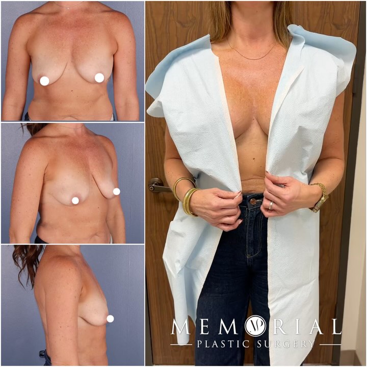 This beautiful patient of mine wanted only a Breast Lift w/ Implants. We kept it simple, refined, and exactly what she envisioned.🤩 The results fit her perfectly!👌🏻
Procedure: Breast Lift w/ Implants + Lipo to Axilla✨
(Pre-Sx Wt: 167.4 Ht: 5’10 BMI: 24.0)
#breastaugmentation #boobjob #breastlift #femaleplasticsurgeon #houstonplasticsurgeon @memorialplasticsurgery