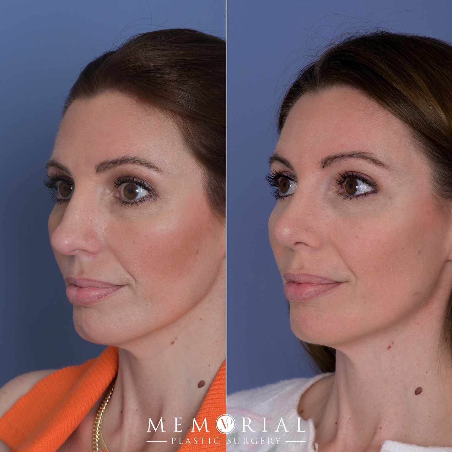 It’s the little tweaks. This wonderful patient’s nose still fits her face and looks like the nose she’s always had, but we’re more refined in the tip, elevated, and sculpted. We’re both loving the result less than three months later.
Procedures:
🔹Rhinoplasty
🔹Septoplasty
@memorialplasticsurgery