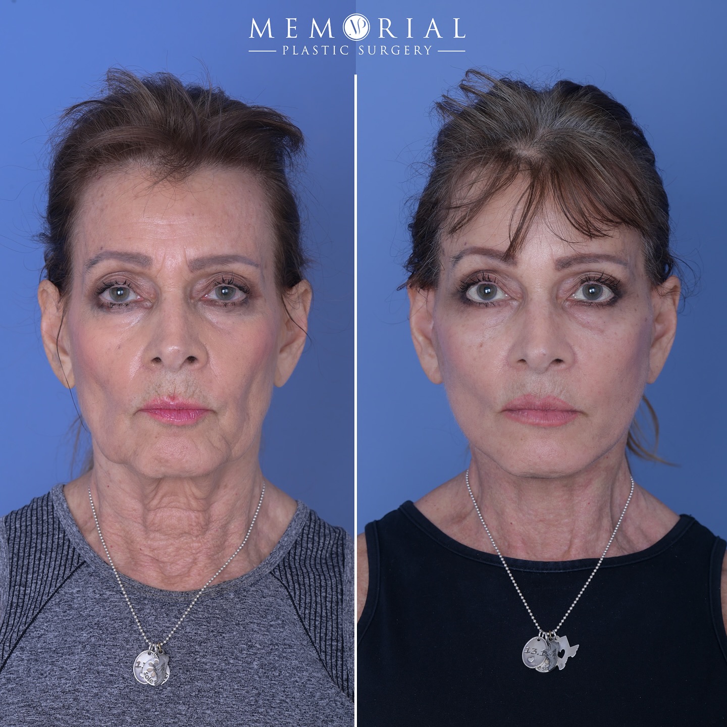 This is 70 going on 50! Or as I like to say, 21 with a few years experience.
We’re only ☝🏻 month post-op and already loving the results. A little swelling is still on board as we expect (remember folks — it’s spectacular but it is a journey!) but it will continue to refine. The crisp jawline, sharp neckline, and youthful repositioning of the face all lends itself to this elegant, natural result. 🤌🏻
Procedure:
🔹 Extended Deep Plane Facelift
🔹 Deep Structural Neck Lift (with gland contouring)
🔹 Endoscopic Brow Lift
🔹 Facial Fat Grafting
🔹 CO2 Laser Resurfacing
As always, I’m overjoyed for her and honored to be part of her journey!
#facelift #necklift #drmcelwee #facialplasticsurgery #MPSFace @memorialplasticsurgery