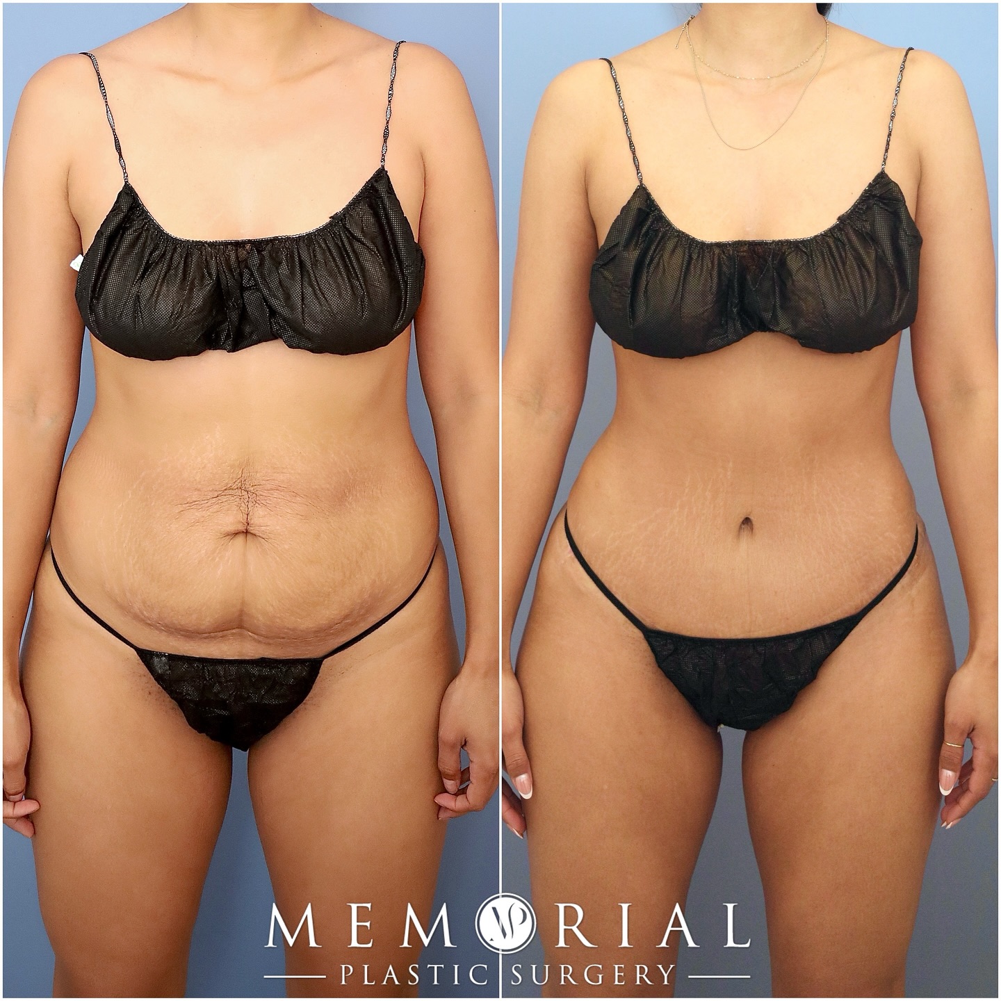 Beautiful & natural results at 7 months post-op 🔥🔥

Procedure: Tummy Tuck, Lipo360 + Skinny BBL (Pre-Sx Wt: 130 lbs Ht: 5’3 BMI: 23)

#mommymakeover #beforeandafter #houstonplasticsurgeon #tummytuck #plasticsurgery @memorialplasticsurgery