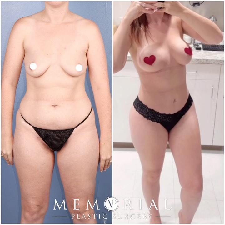 Confidence looks beautiful on this lovely patient of mine!😍🤩👏🏻
Procedure: BBL, Lipo to Flanks, Tummy Tuck + Breast Augmentation🔥
(Pre-Sx Wt: 127lbs Ht: 5’3 BMI: 22.5)
#beforeandafter #newbody #bodytransformation #plasticsurgery #femaleplasticsurgeon @memorialplasticsurgery