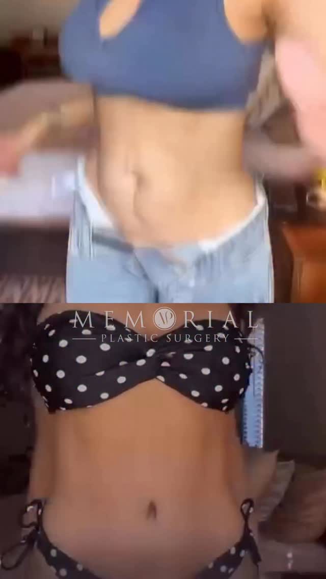 3 months post-op Mommy Makeover🔥🔥🔥 

Procedure: Tummy Tuck, Breast Reduction, Lipo360 
(Pre-Sx Wt: 122.6 lbs Ht: 5’2 BMI: 22.42)

#drhsu #texassurgeons #plasticsurgery #houstonplasticsurgeon #mommymakeover @memorialplasticsurgery