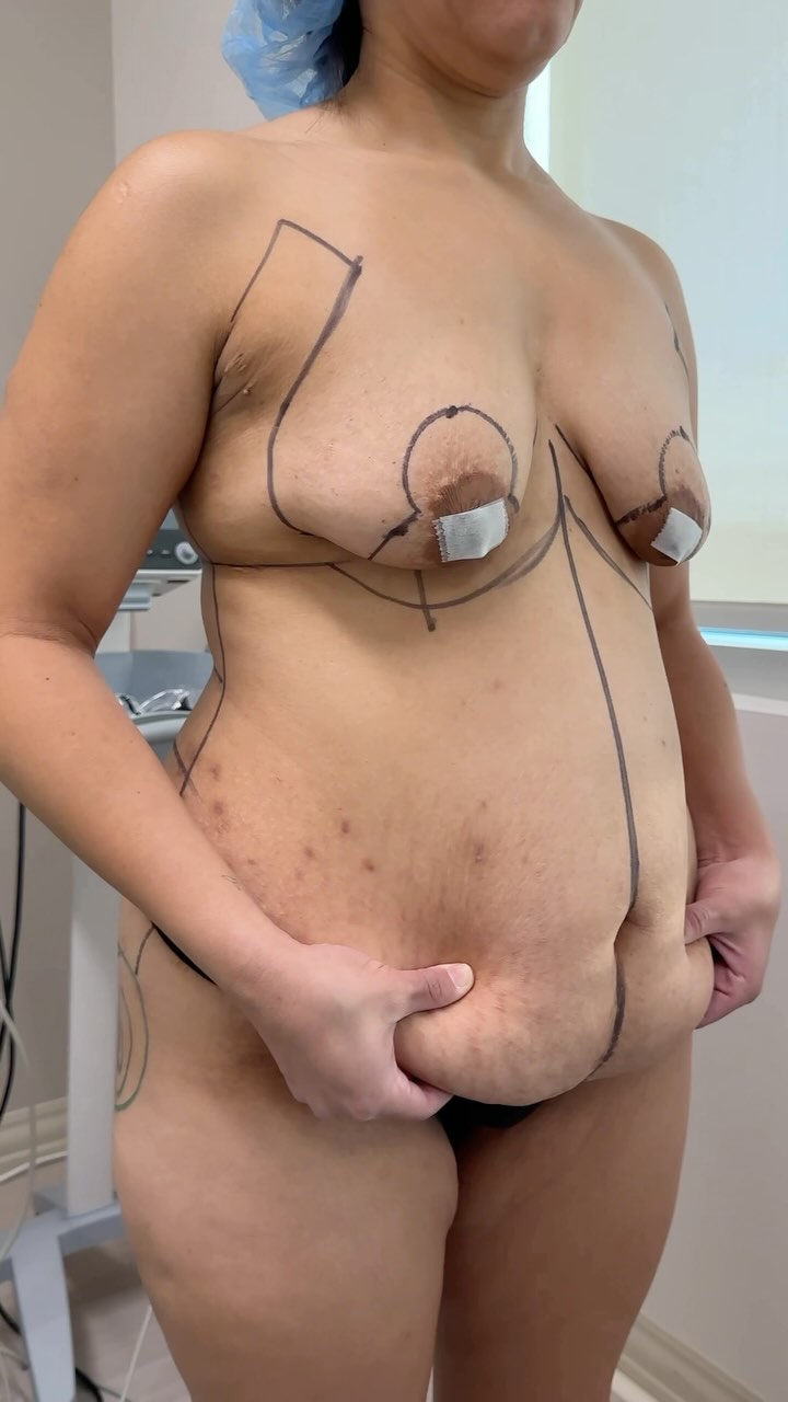 Beautiful before and after on-table transformation🤩😍👏🏻

Procedure: BBL, Lipo360, Tummy Tuck + Breast Lift
(Pre-Sx Wt: Wt: 157.4lbs Ht: 5’3 BMI: 27.9)

#beforeandafter #newbody #bodytransformation #liposuction #femaleplasticsurgeon #memorialplasticsurgery @memorialplasticsurgery