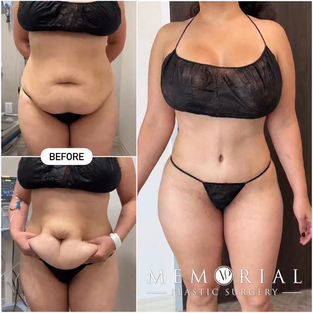 Perfection! 4.5 months post-op from extended tummy tuck. We achieved a thin, tight and well-defined contour, a normal-looking belly button, and a low, thin scar that is hidden below underwear and swimwear! 🔥🙏🏼

Procedure: Ext. Tummy Tuck + Lipo to flanks 
(Pre-Sx Wt: 165 lbs Ht: 5’6 BMI: 26.6)

#drvasilakis #mommymakeover #bodytransformation #transformation #tummytuck #plasticsurgeon @memorialplasticsurgery