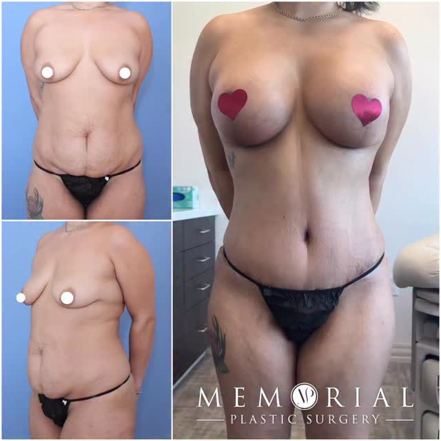 Elegant breast and body transformation at 6 months post-op. Excellent scar healing and position. Natural result is always the goal 🔝🔥

Procedure: Tummy Tuck, Breast Lift w/ implants (365 cc), Lipo to abdomen + flanks, Fat Grafting to breasts. 
(Pre-Sx Wt: 150 lbs Ht: 5’2 BMI: 27.4 Bra Size: 36A)

#beforeandafter  #mommymakeover #transformation #bodytransformation #breastliftwithimplants #postopresult #plasticsurgery #houstonplasticsurgeon @memorialplasticsurgery