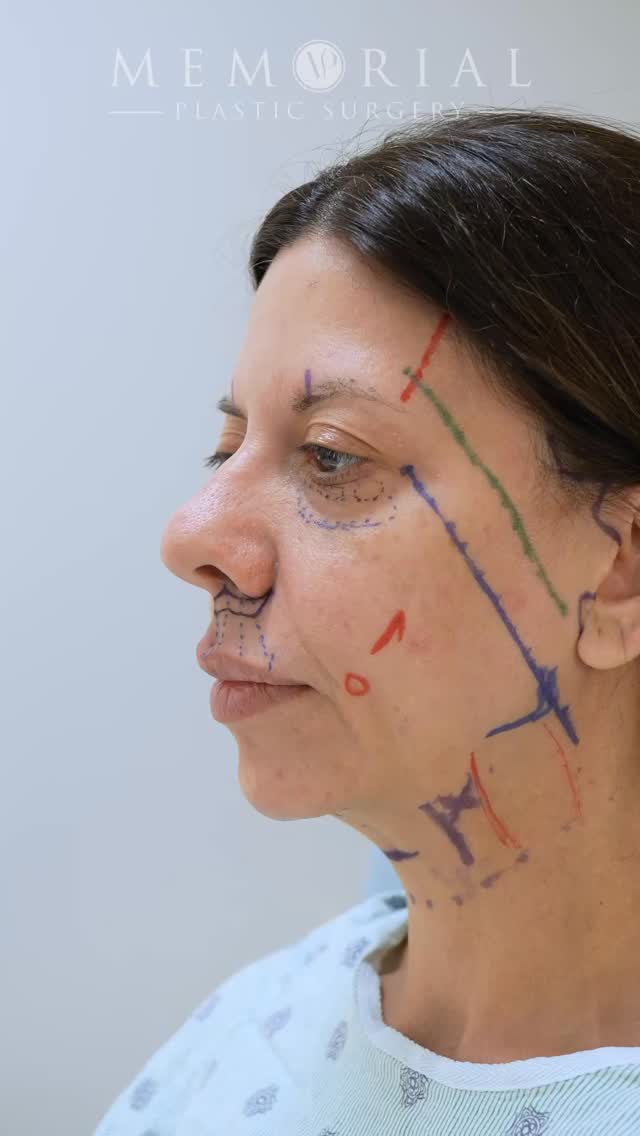 Blossoming 🌸
We’re just a few months out from a full facial rejuvenation (see all the deets below!). Ecstatic doesn’t begin to describe it. We’re entering a new era of a younger, more refreshed her. We’ve lifted up the volume that’s fallen, restored those youthful contours, and given the face and neck a softer, more elegant feel. These are the kinds of transformations I strive to make every day.
And it couldn’t be a more wonderful, caring patient. I want to specifically give her credit for being brave and putting herself out there. You can follow along with her entire journey from preoperative prep work to every single day postop on her TikTok @jeniskitchenfamily2 .
She did this on her own accord so she could help others understand what they’re getting in to and how to best prepare. I cannot thank her enough, and I know for a fact she has informed and touched so many people in this process.
Procedure(s):
🔹 Extended deep plane face lift
🔹 Deep structural neck lift with gland contouring
🔹 Endoscopic brow lift
🔹 Deep plane lip lift
🔹 Lower lid blepharoplasties
🔹 Fat grafting to the under eyes
🔹 Full face CO2 laser resurfacing