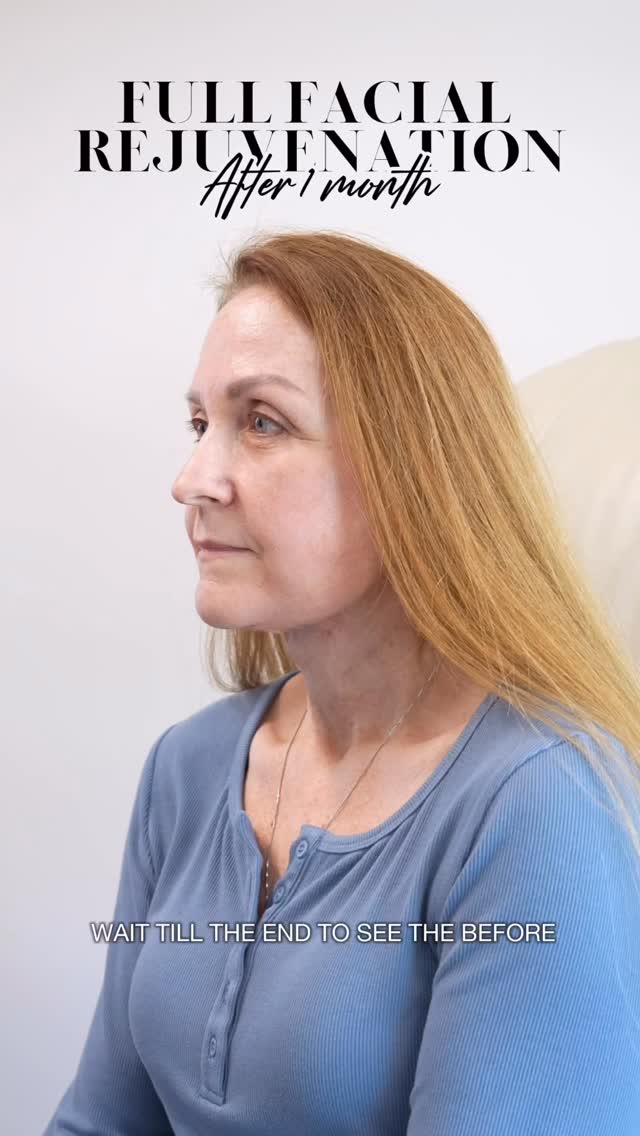 Defying gravity.
Love this result so much for such a resilient, wonderful patient. Elegant, refined, and still looks like her. And it’ll only get better.
Procedure(s):
🔹Deep plane facelift
🔹Deep structural neck lift with gland contouring
🔹Endoscopic brow lift
🔹Lower lid blepharoplasty
🔹Fat grafting
#drmcelwee #facialrejuvenation #facialplasticsurgeon #houstontx #MPSFace @memorialplasticsurgery